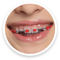 smilebraces2
